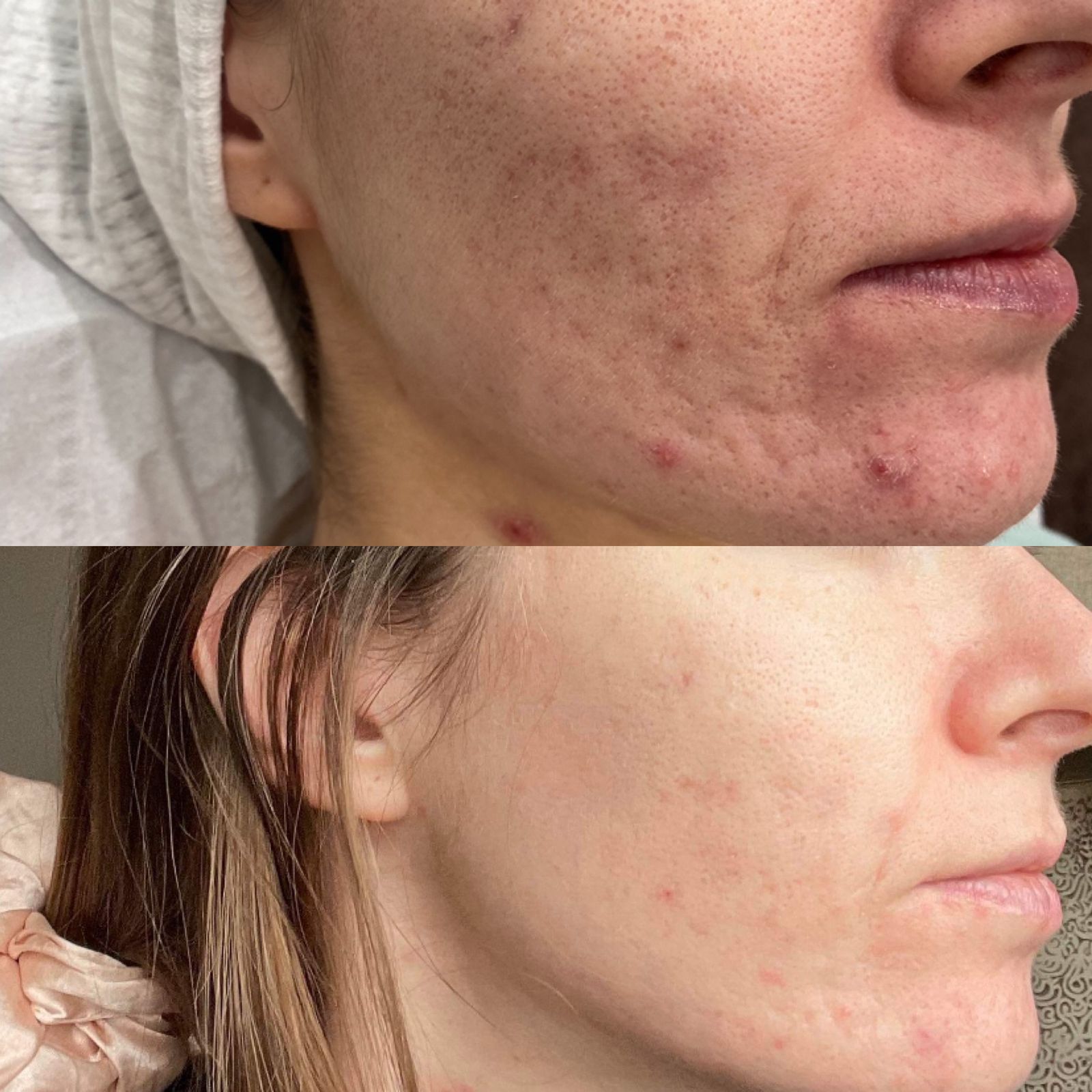 CO2 Laser Acne Scarring Before and After Results