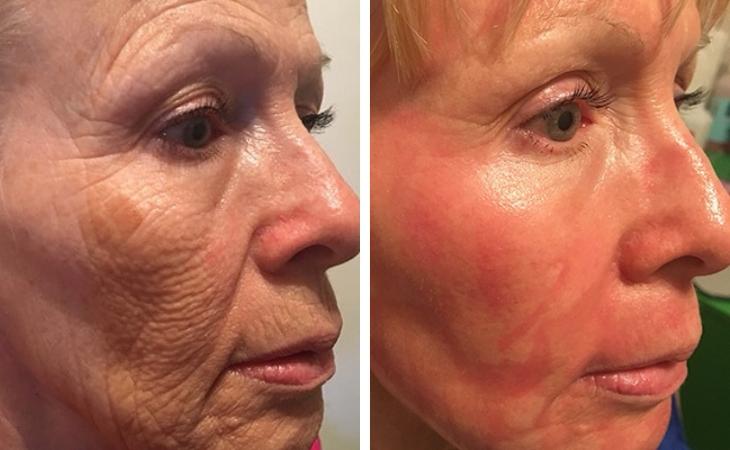 CO2 Laser Treatment Results