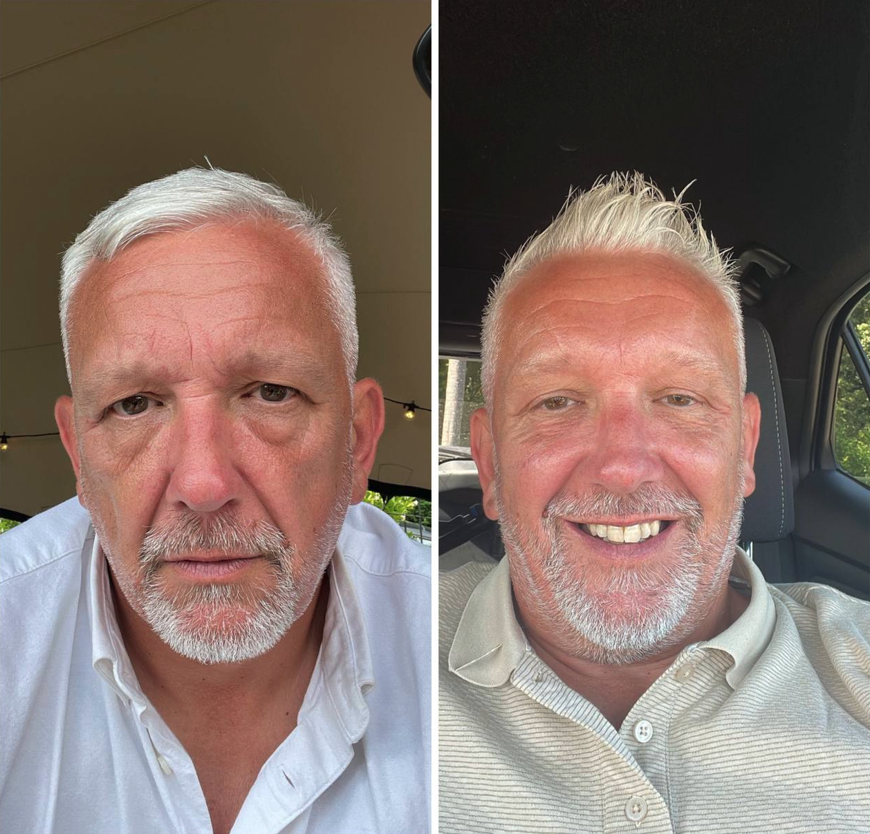 CO2 Laser Male Skin Rejuvenation Before and After