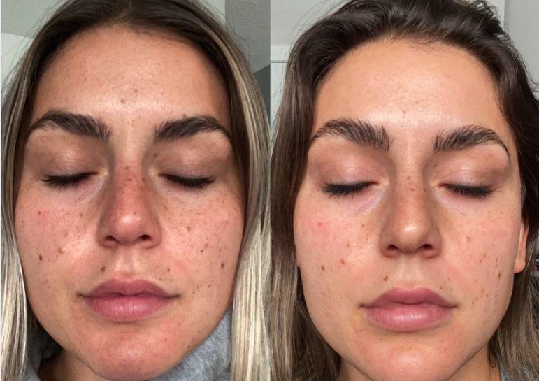 CO2 Laser Pigmentation Treatment Results