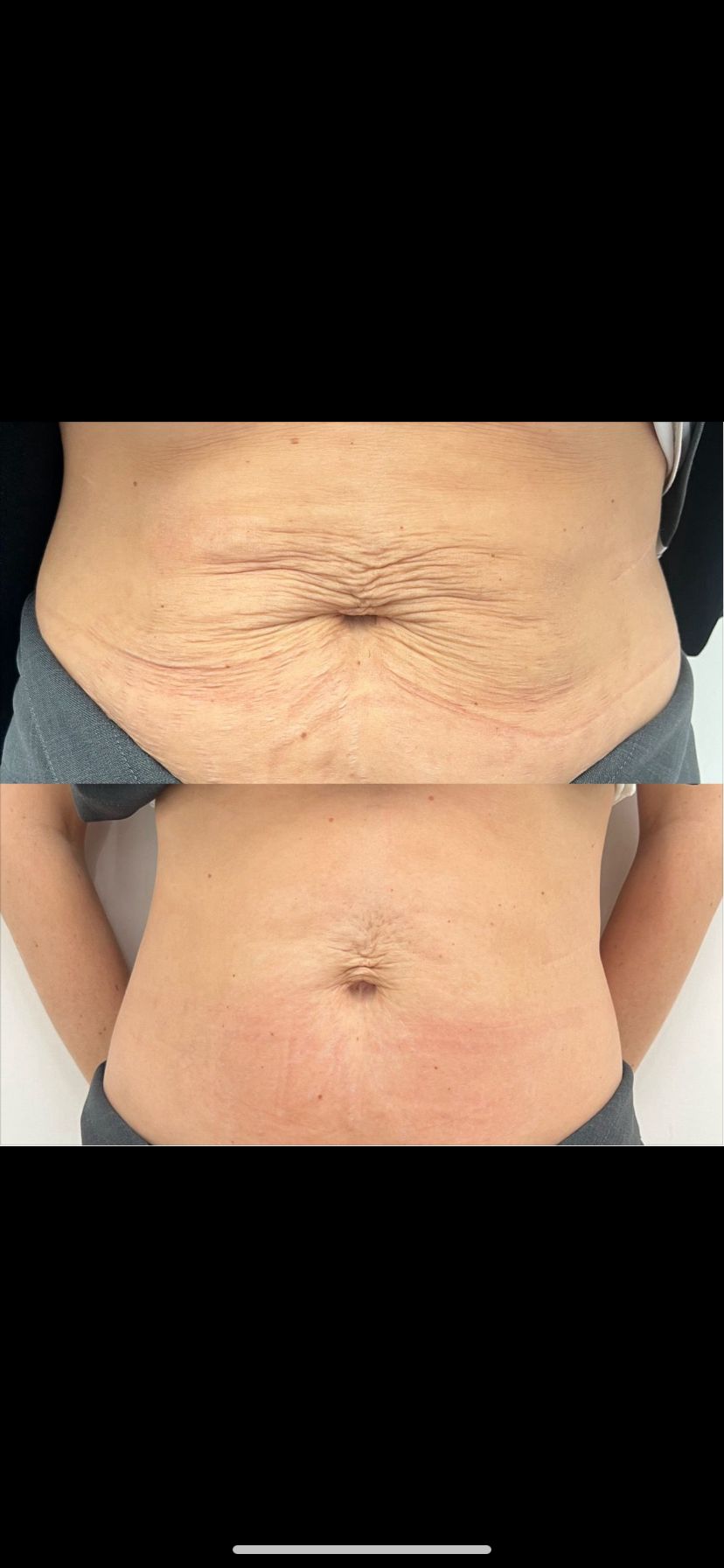 CO2 Laser Stretch Marks Before and After