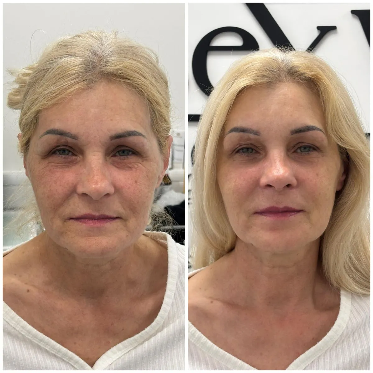 HIFU Full Face Before and After Results