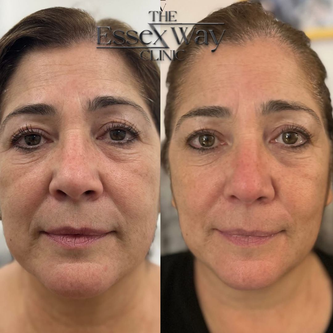 HIFU Treatment Before and After Results