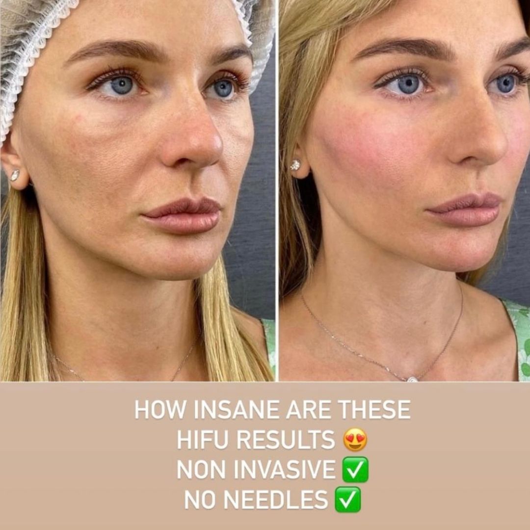 HIFU Full Face Treatment Results