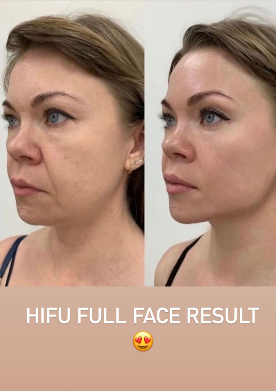 HIFU Full Face Side Profile Results
