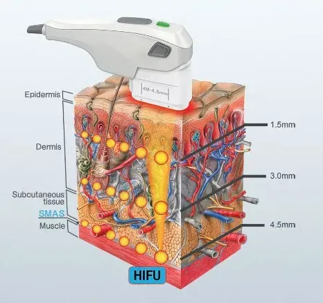 3D HIFU HIFU Device - How It Works
